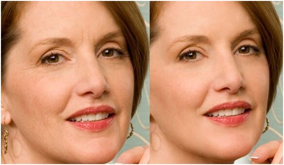 prima e dopo il ringiovanimento della pelle del viso al plasma