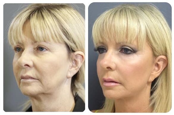 prima e dopo il ringiovanimento della pelle con foto rassodante 2