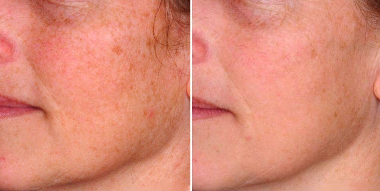 Il risultato della fototermolisi frazionata è la riduzione delle macchie senili sulla pelle del viso. 