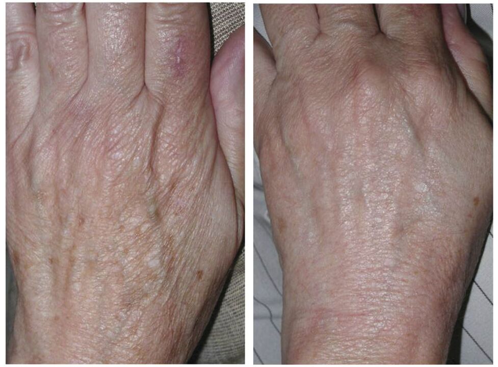 ringiovanimento laser delle mani prima e dopo le foto